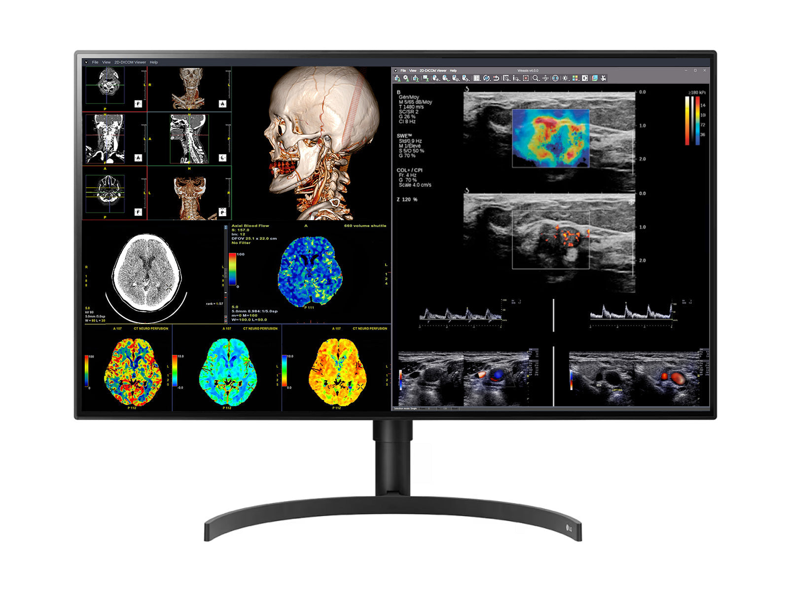 Monitor Médico LG 32HL512D-B 8MP – 32" – Color – Radiología Diagnóstica DICOM (1)