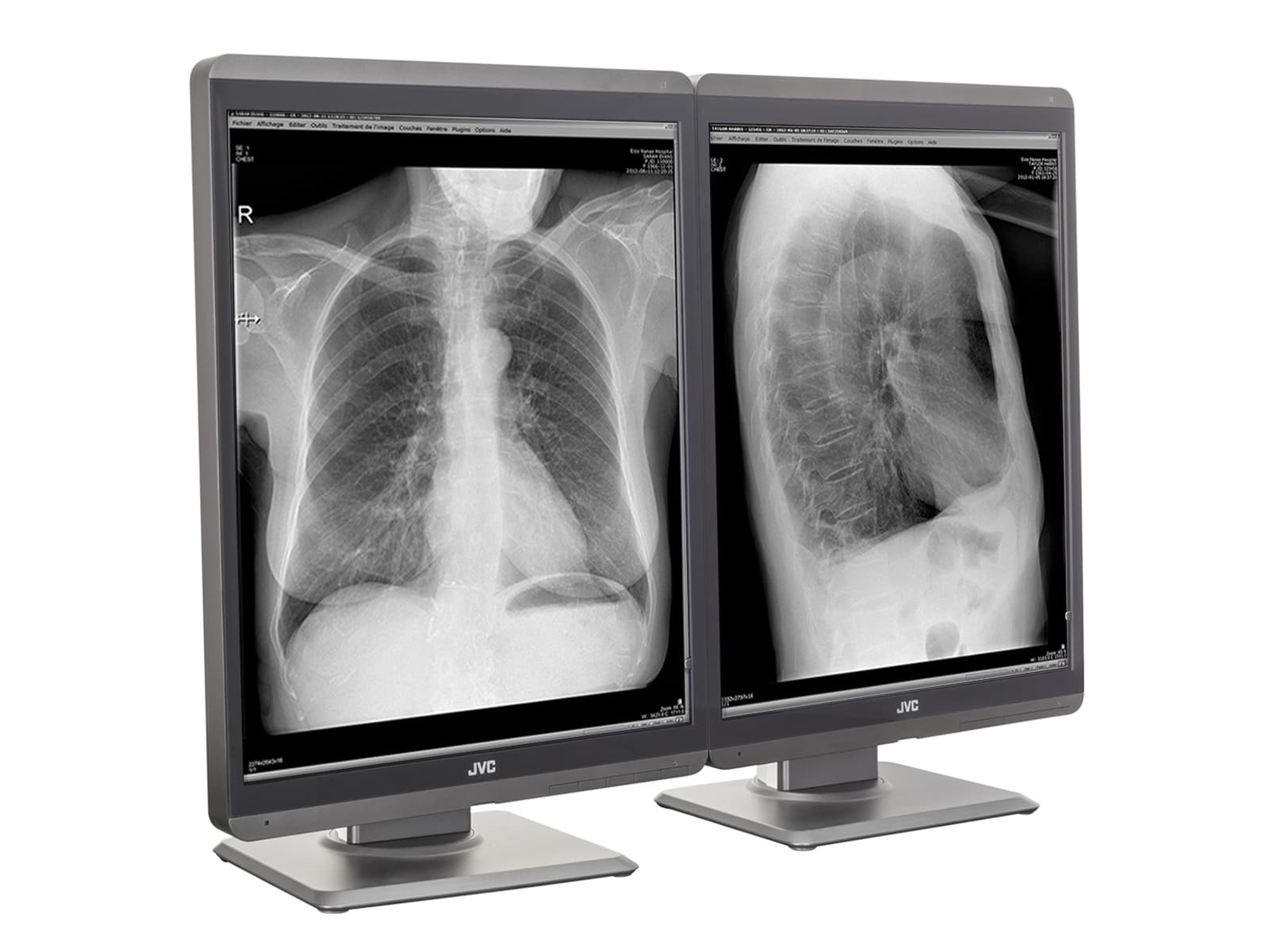 Monitor Médico JVC MS-S300 3MP – 21.3" – Escala de grises – Radiología Diagnóstica DICOM (2)