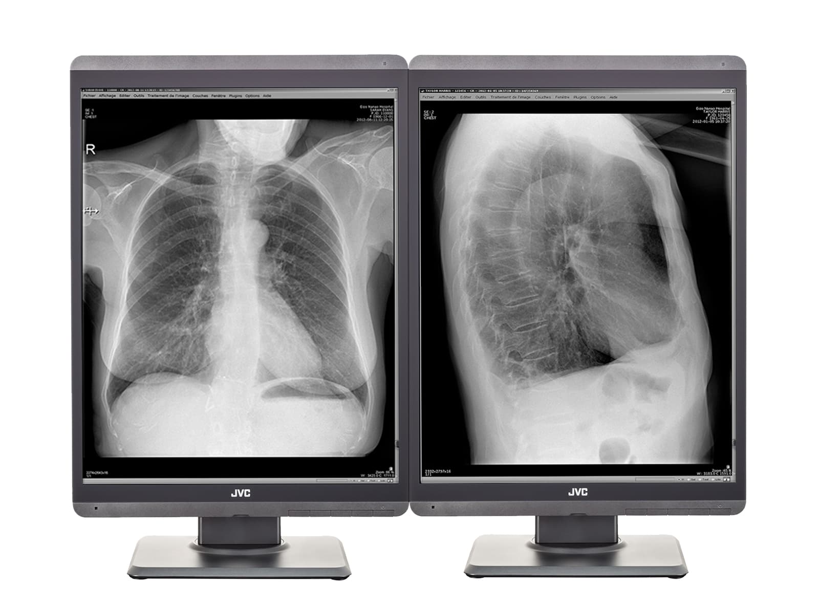 Monitor Médico JVC MS-S300 3MP – 21.3" – Escala de grises – Radiología Diagnóstica DICOM (1)