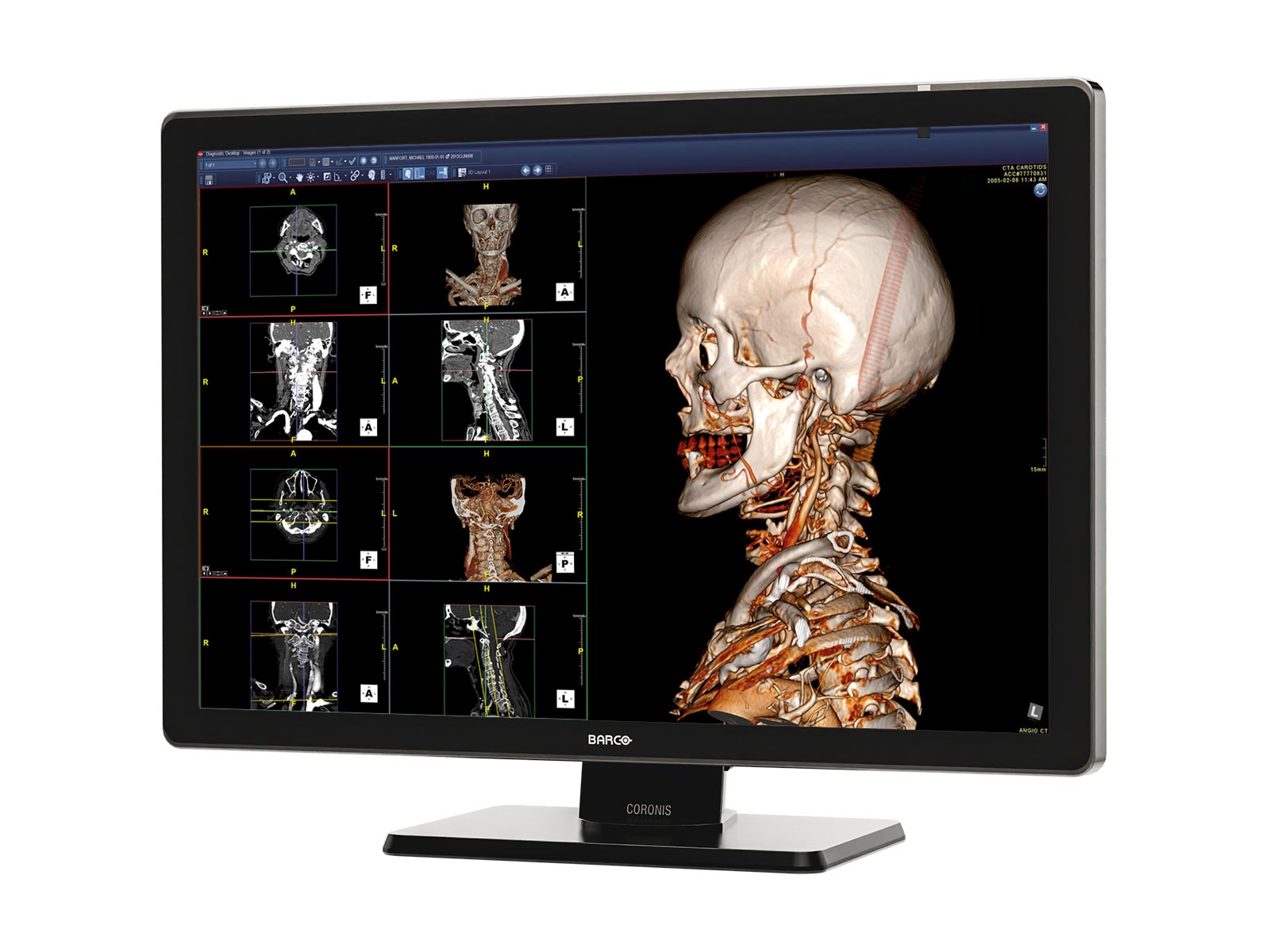 Monitor Médico Barco MDCC-6530 6MP – 30.4" – Color – Radiología Diagnóstica DICOM (2)