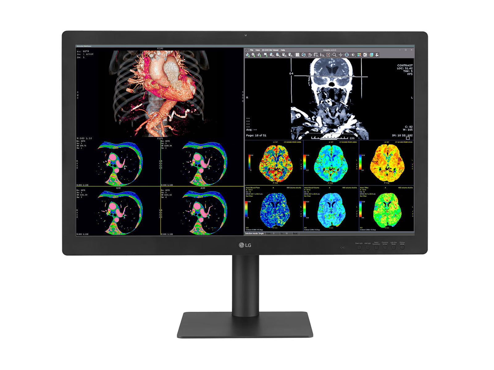 Monitor Médico LG 32HQ713D-B 8MP – 32" – Color – Radiología Diagnóstica DICOM (1)