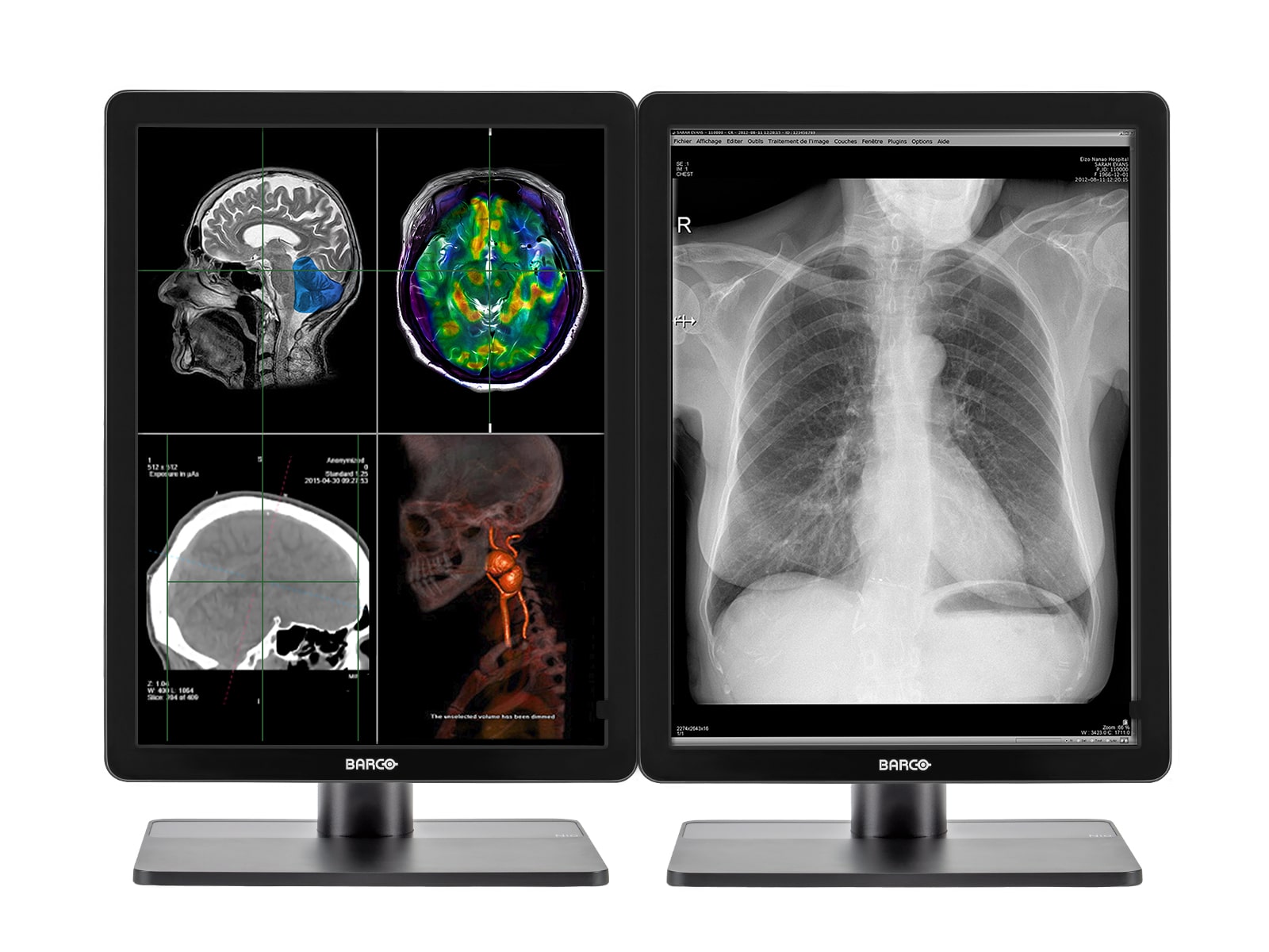 Monitor Médico Barco MDNC-2221 2MP – 21" – Color – Radiología Diagnóstica DICOM (1)