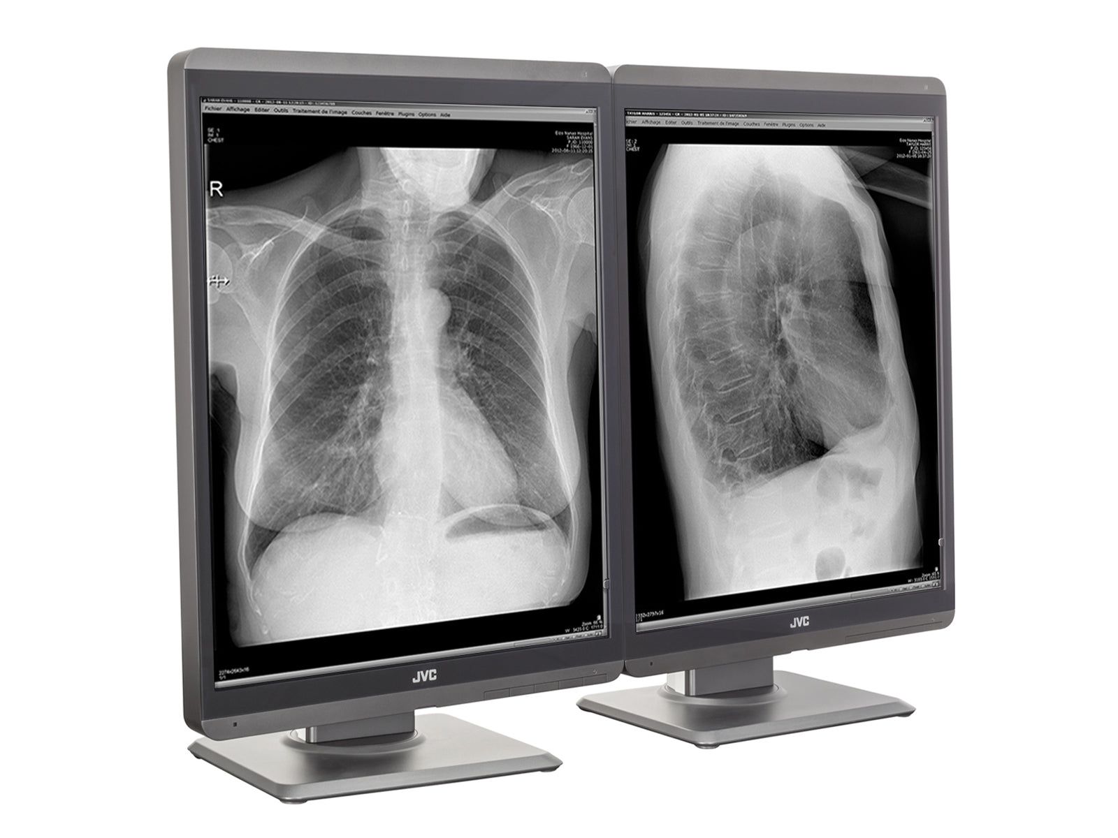 Monitor Médico JVC MS-S200 2MP – 21.3" – Escala de grises – Radiología Diagnóstica DICOM (2)