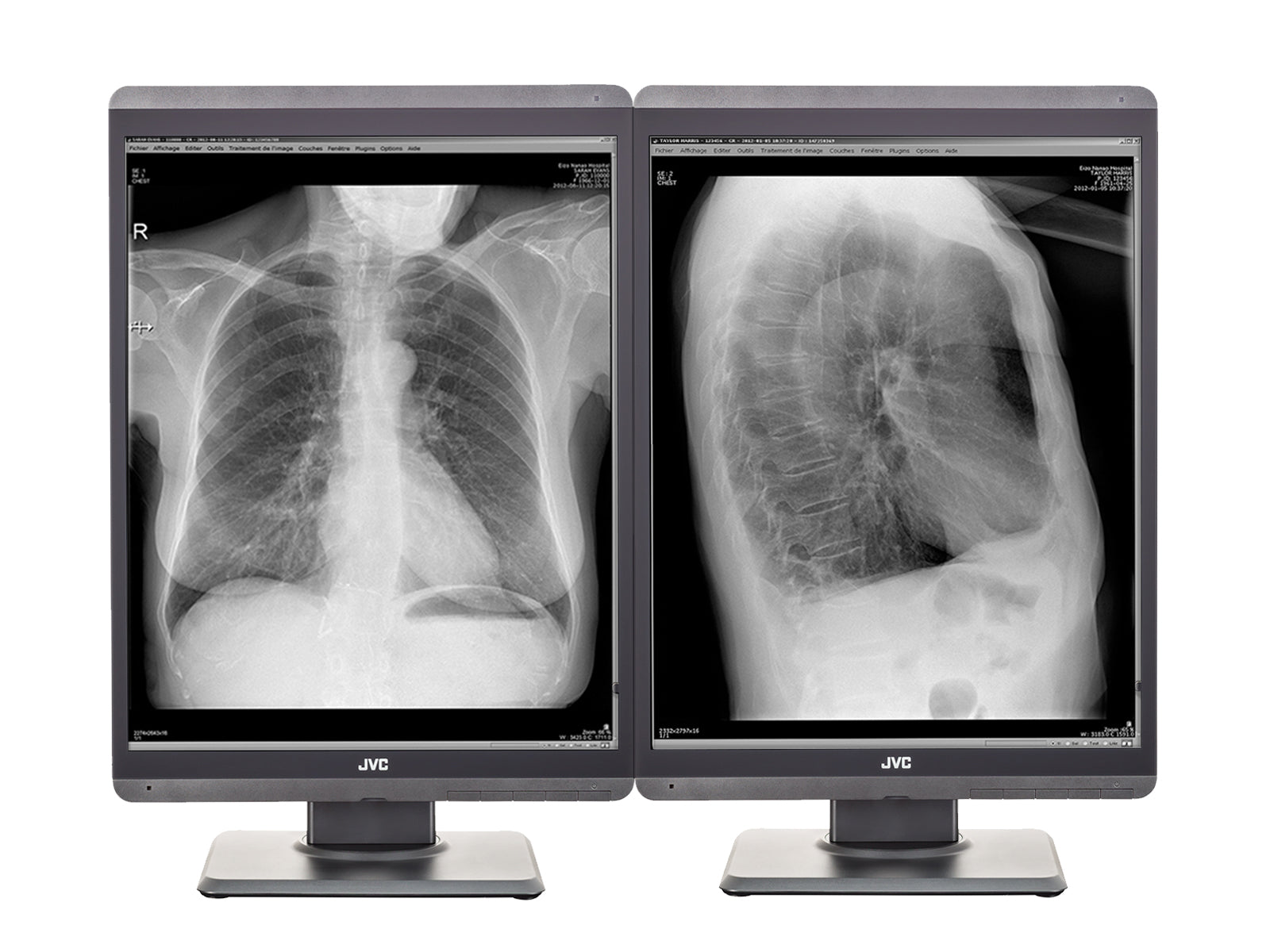 Monitor Médico JVC MS-S200 2MP – 21.3" – Escala de grises – Radiología Diagnóstica DICOM (1)