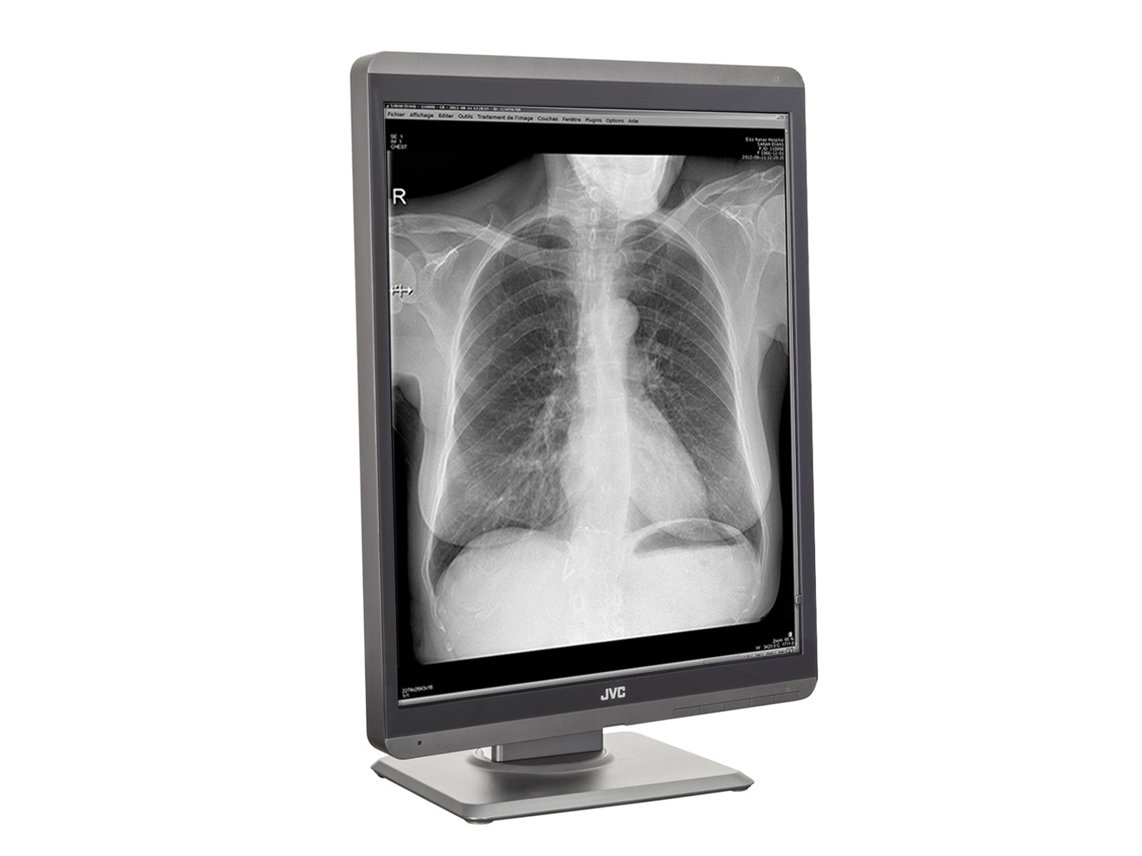 Monitor Médico JVC MS-S200 2MP – 21.3" – Escala de grises – Radiología Diagnóstica DICOM (6)