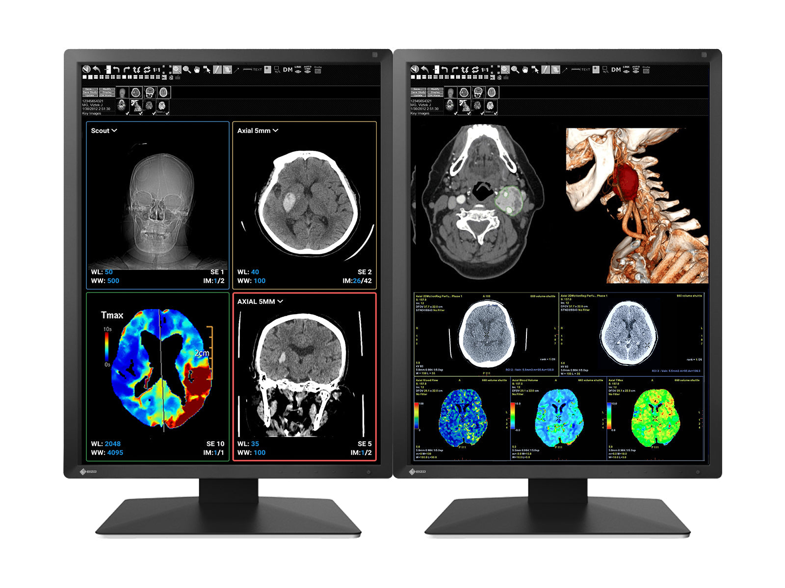 Monitor Médico Eizo MX217-BK 2MP – 21" – Color – Radiología Diagnóstica DICOM (1)