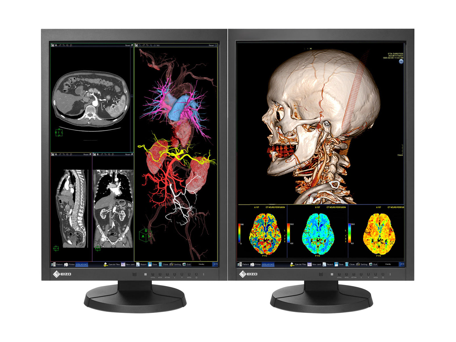 Monitor Médico Eizo MX215-BK 2MP – 21" – Color – Radiología Diagnóstica DICOM (1)