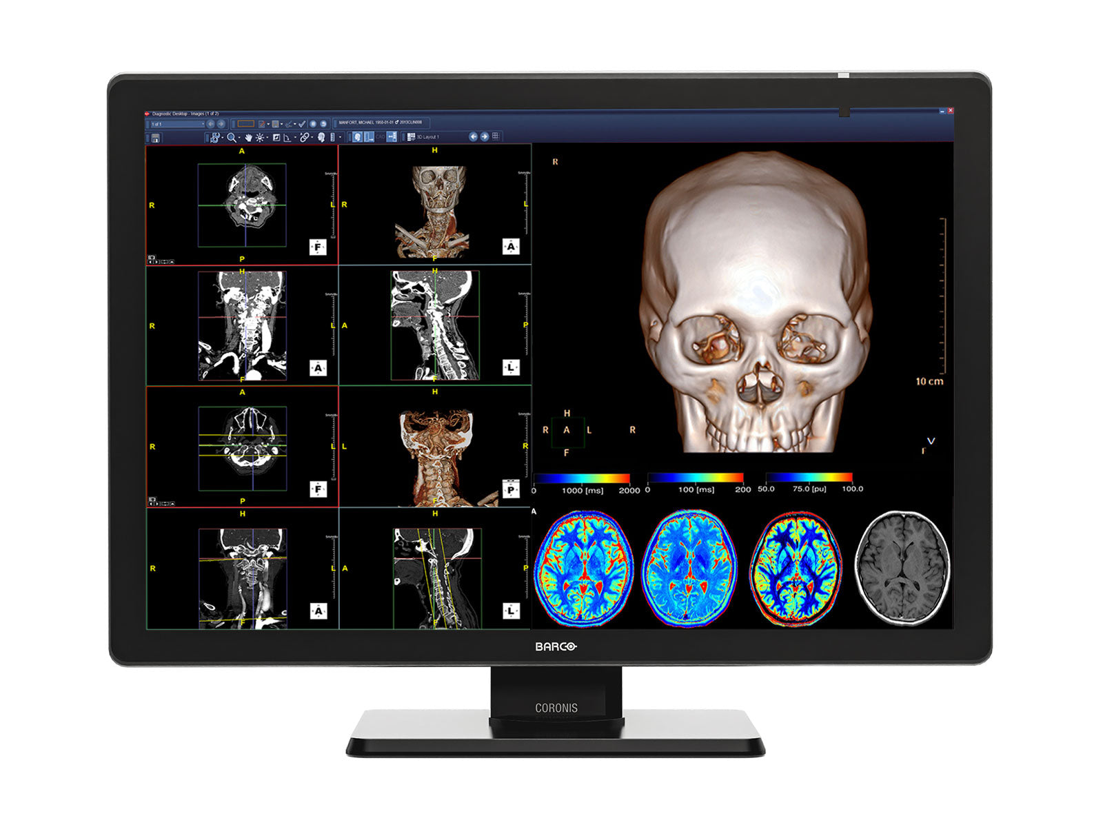 Monitor Médico Barco MDCC-4430 4MP – 30.4" – Color – Radiología Diagnóstica DICOM (1)